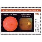 Periodieke controle oogdruk spoort glaucoom sneller op - 4